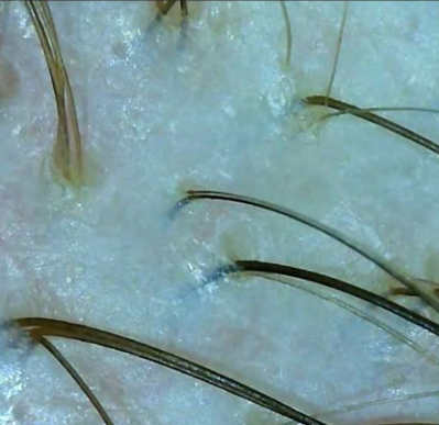 Результат трихоскопії - волосяні фолікули